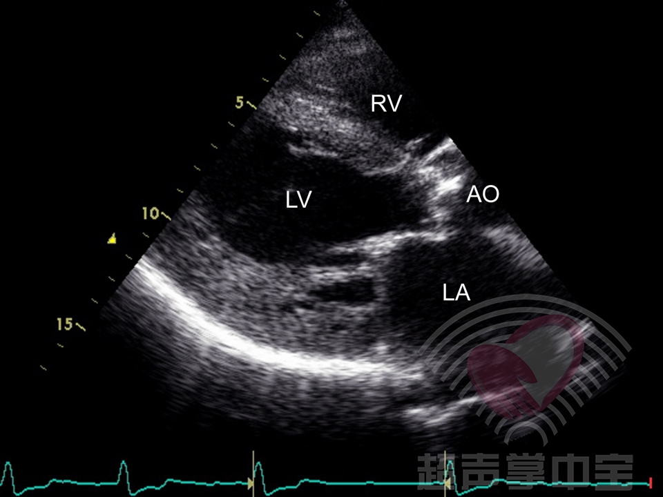 主动脉缩窄图片